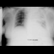 Pleural effusion, lung tumour: X-ray - Plain radiograph